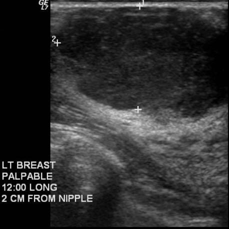 Tubular Adenoma Lactating Adenoma Ultrasound shows a lobulated