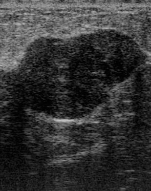 fibroadenoma Ultrasound shows a well circumscribed, slightly