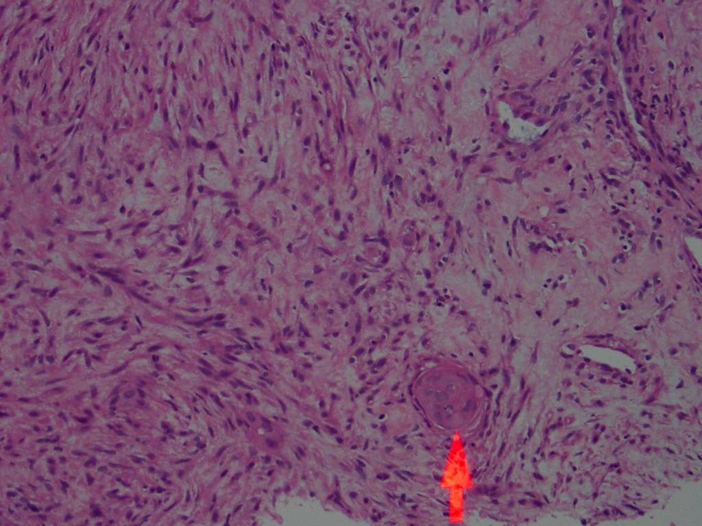 Metaplastic Carcinoma- Spindle Cell Type Higher