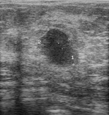 Ultrasound shows two hypoechoic masses which