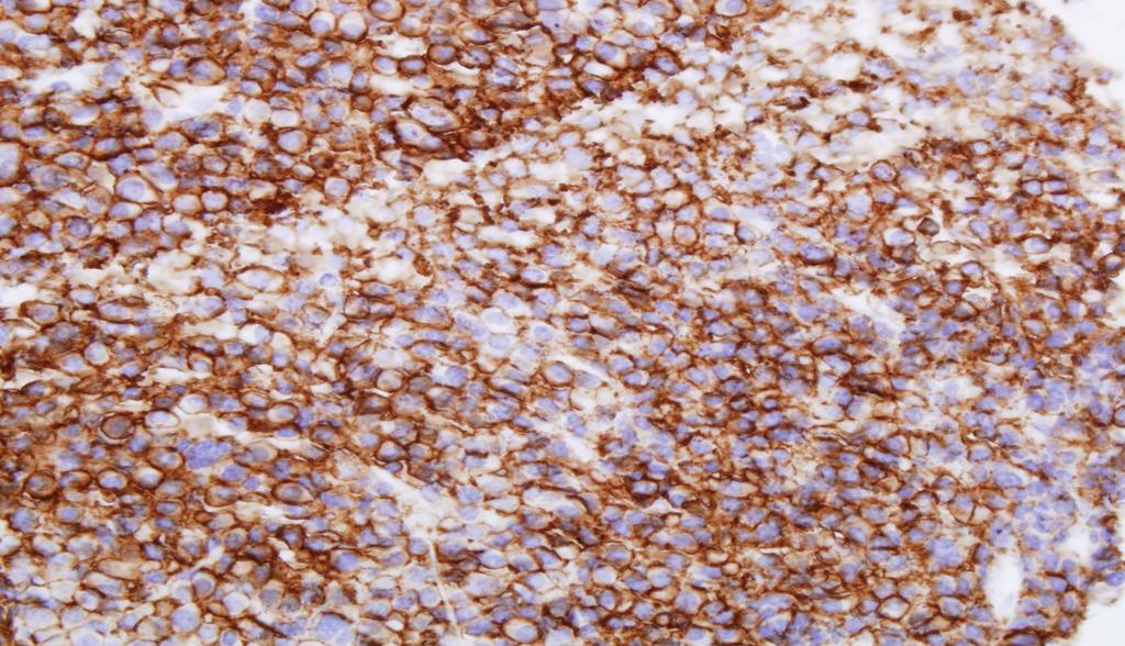 Plasmacytoma Tumor cells are