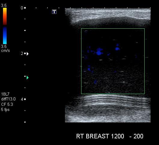 30 yo F with h/o recent breast reduction