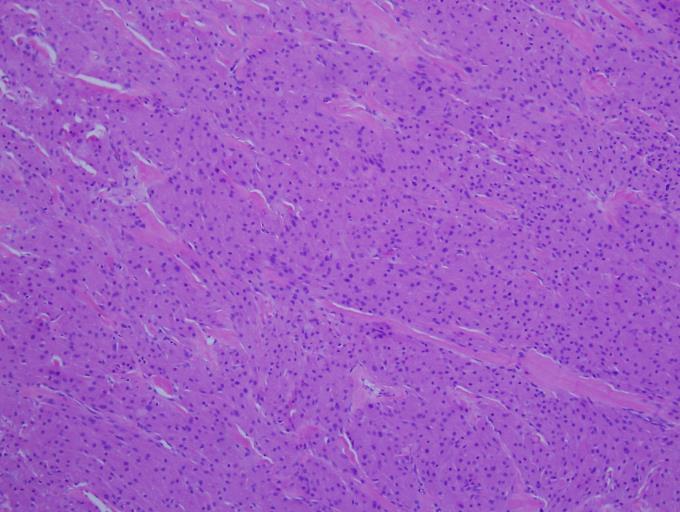 Granular Cell Tumor Cells contain abundant