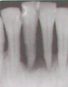 During the second step, the apex area of each of the treated teeth was irradiated in a non-contact manner by circling the R24 handpiece over the tissue for 3 x 40 sec, using the following Nd:YAG