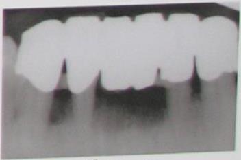 RESULTS Figures 1, 2 and 3 show the photographs and radiographic images of the patient s teeth before the start of the treatment, and at 2.5 months and 1 year post-treatment, respectively.