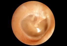 Middle Ear Disorders:
