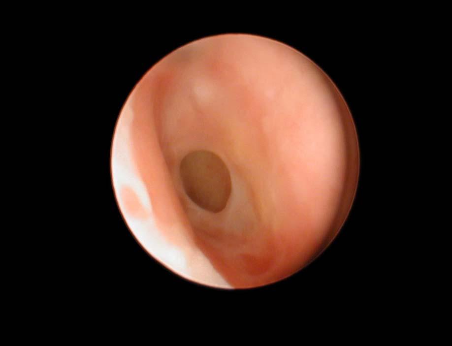 Complications of Untreated Otitis