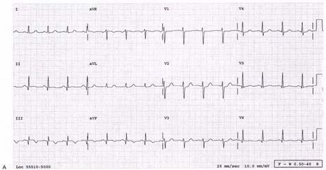 Recent Inferior MI Acute Inferior MI Case 4 A 25-year-old female is brought to