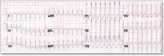 Case 6 A 53-year-old male presents to the emergency room with dyspnea on exertion and near syncope.
