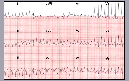 Case 9 A 38 year old female without prior cardiac history presents to the emergency room for evaluation of progressive dyspnea on exertion.