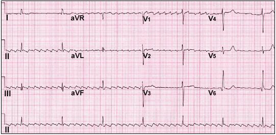 VT (AV Dissociation) Case 11 A 74-year-old female with a history of hypertension presents for her annual physical.