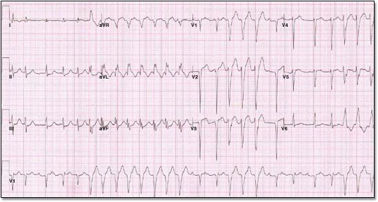 Acute Myocarditis Ventricular Tachycardia Case 13 A sixty-nine-year-old female presents to the emergency department with symptoms of
