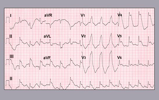 Case 14 A 71-year-old female presents to the emergency room with chest pain, shortness of breath,