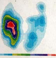 This is a thyroid isotope scan.