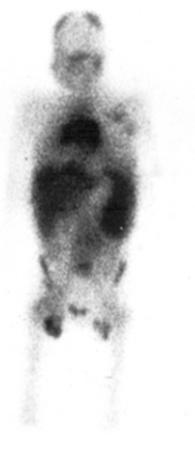 Gallium-67 Scans Figure 2.