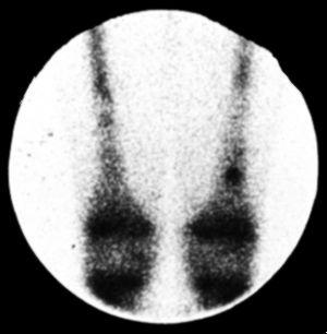 Gallium-67 scan showing uptake in the left femur (dark area) just above the knee.