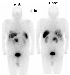 Somatostatin Receptor Imaging Gabriel Soudry, M.D. Kevin J Donohoe, M.D. May 30, 1995 Case Presentation: A 62 year-year-old man presented with severe diarrhea, weight loss and increased flatulence.