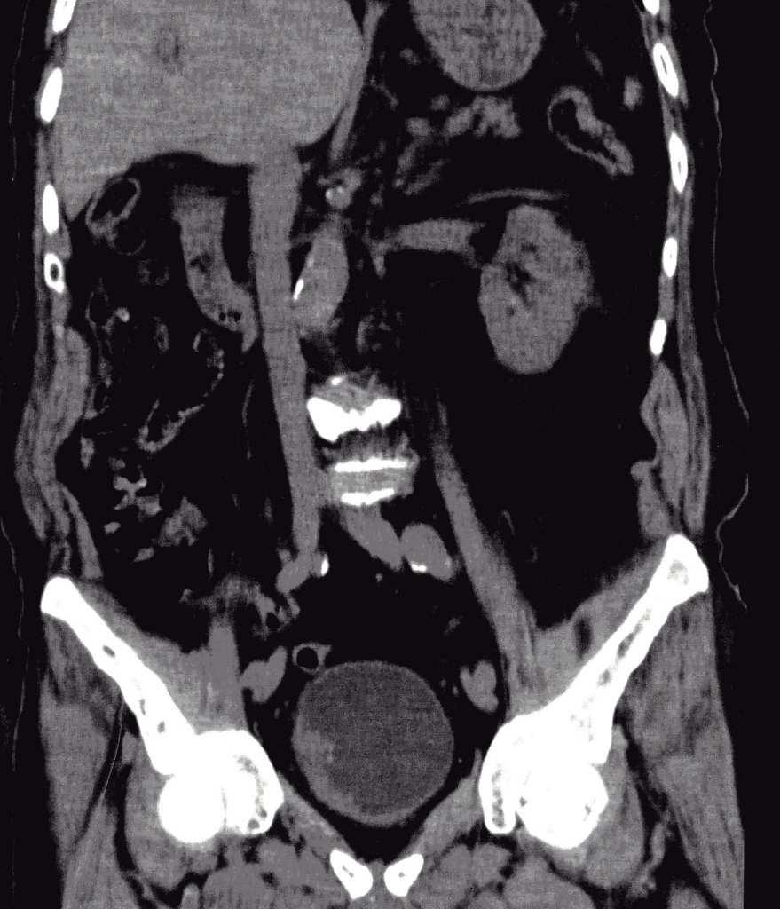 153 154 155 156 Figure 2: Coronal section of plain abdominal CT.