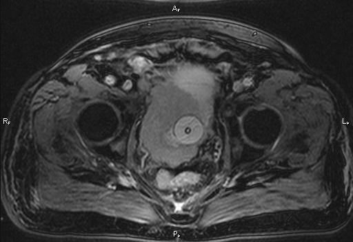 Figure Figure 1: MRI demonstrating