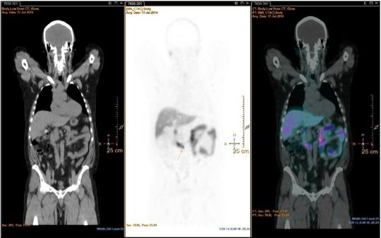 Pelvic lymph node dissection for nodal oligometastatic prostate cancer