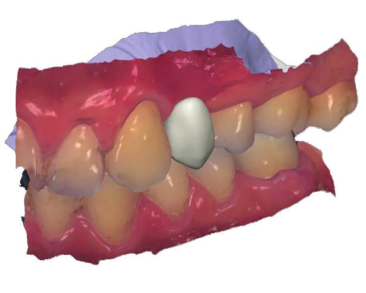 the related tooth, which will guide the planning of the implant