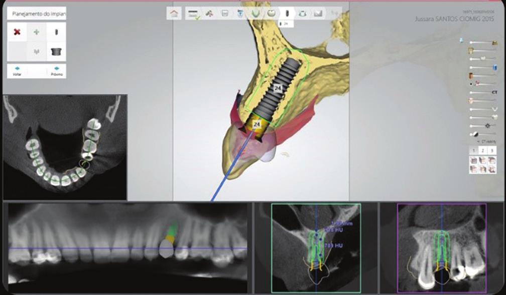 Implant Studio has accurate and optimized positioning and