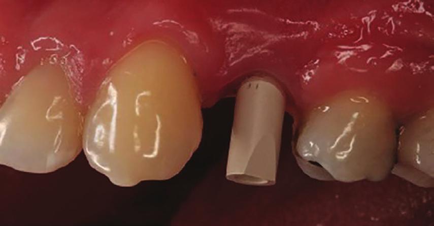 To register the implant position and the crown manufacturing, a scanbody was attached to the implant and its