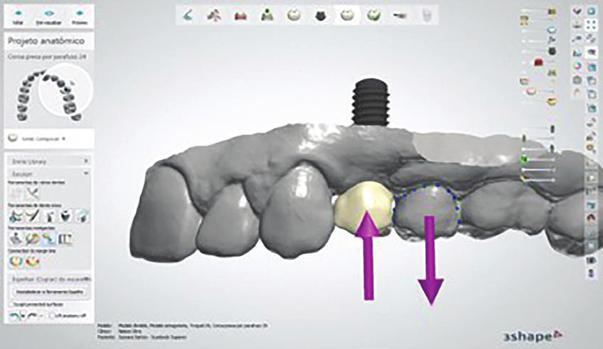After scanning, the 3D images were designed in the Dental System software, with the purpose of starting the