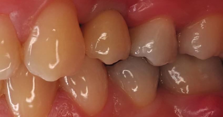 Crown placement and digital adjustment of proximal and occlusal contacts, in order to mill the crown with
