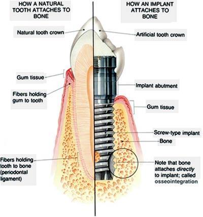 Fig.1 Structure of dental implant Because implants fuse to your jawbone, they provide stable support for artificial teeth.