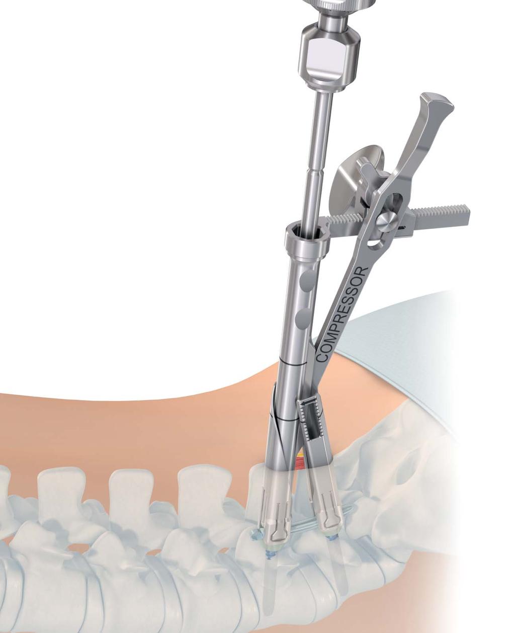 MATRIX Spine System MIS Instrumentation. A minimally invasive instrument system for use with the MATRIX Spine System.