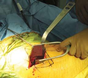 Femoral Resection Procedure 1.