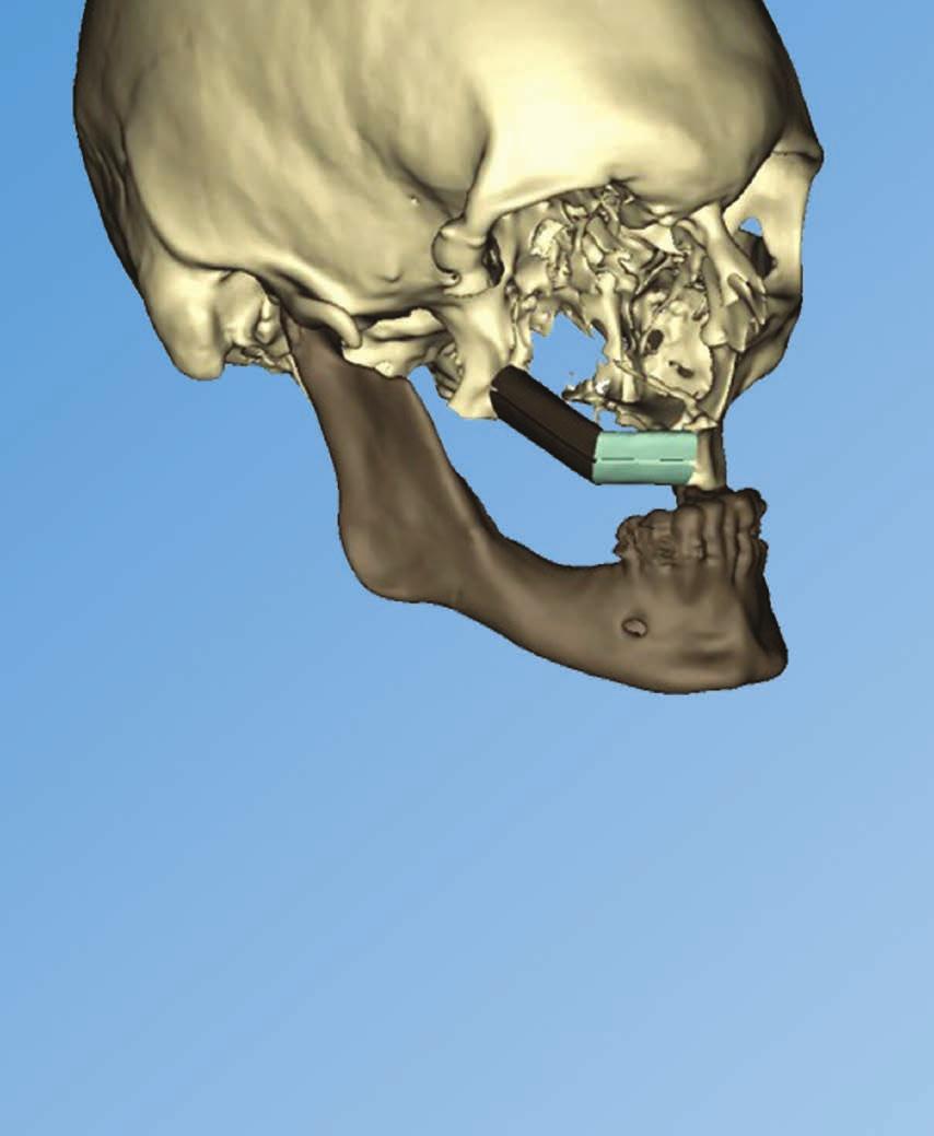 Case Report Reconstruction of a