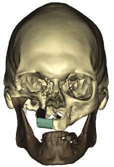Reconstruction of a Maxillary Oncologic Defect with a Fibula Osteocutaneous Flap. Using Synthes ProPlan CMF and the MatrixMIDFACE Plating System.