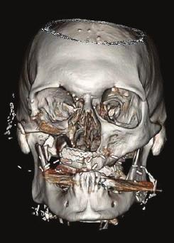 Reconstruction of a Maxillary Oncologic Defect with a Fibula Osteocutaneous Flap. Using Synthes ProPlan CMF and the MatrixMIDFACE Plating System.