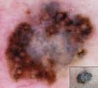 sensitivity of detecting melanoma went from 70% to 83% with the use of dermoscopy based