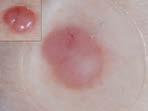 1 The sensitivity for melanoma diagnosis by primary care physicians using dermoscopy