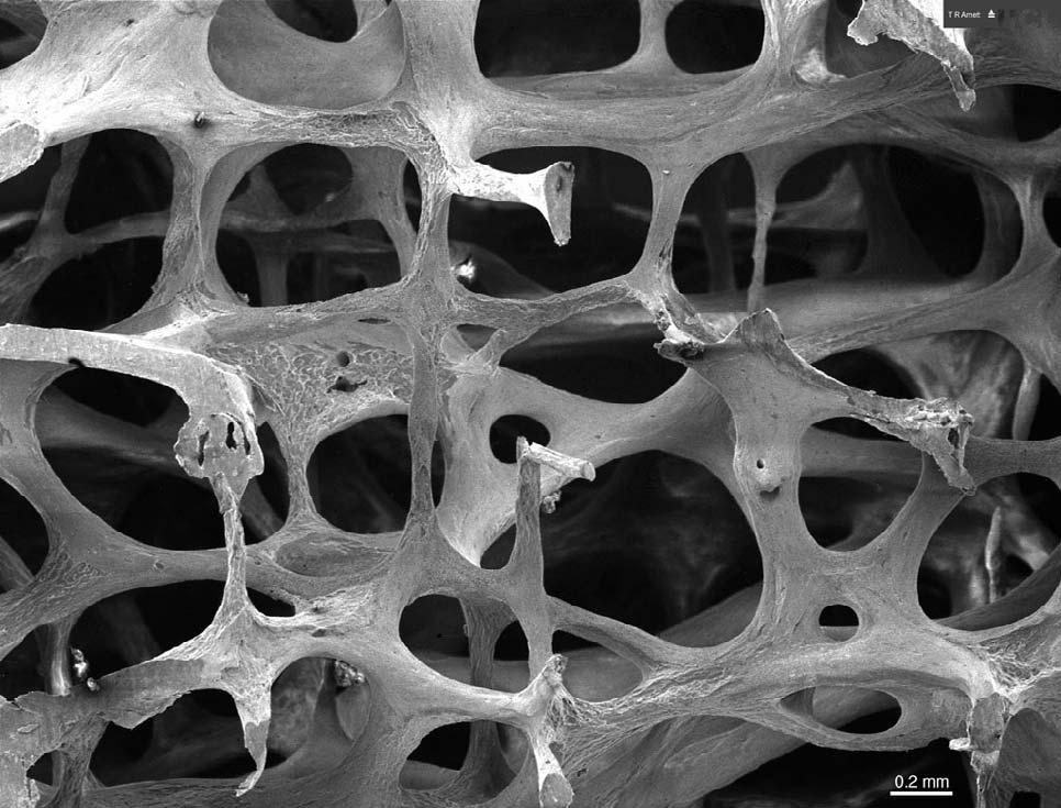 Low-power scanning electron microscope image of osteoporotic bone architecture in the 3 rd lumbar