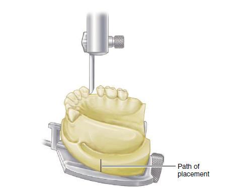 د. فائزة Lec.3 Prosthodontics Surveying The ideal requirements for successful removable partial denture are: 1. Be easily inserted and removed by the patient. 2. Resist dislodging forces. 3.
