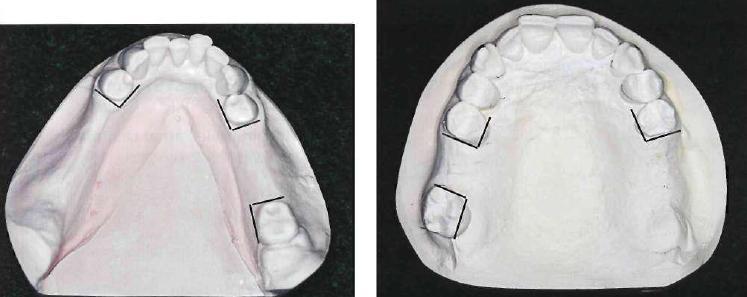 The components of the denture that contact the guiding planes during placement of removable partial denture are: Tooth surface which act as Component of the denture which contact guiding planes this