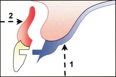 Two distinct paths of insertion will be employed for a sectional,