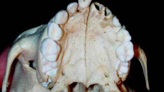 o) All have maxillary constriction w/ dental crowding 6 patients w/