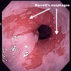 Extraesophageal symptoms of GERD Extraesophageal symptoms occurring in isolation without concomitant symptoms of reflux are rare PPI trial is recommended in patients who also have typical symptoms of