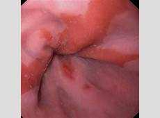 patients Reflux monitoring should be considered before a trial of PPI in those patients without typical symptoms of GERD GERD complications Erosive esophagitis Peptic strictures Schatzki ring Barrett