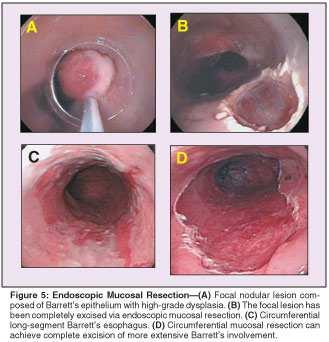 visible dysplastic nodule may be candidates for endoscopic resection Endoscopic mucosal resection (EMR) involves excision of a large segment of mucosa down to the submucosa EMR can be utilized alone