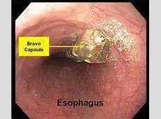 Diagnosis: Esophageal manometry Limited value in the diagnosis of GERD Decreased lower esophageal sphincter pressures or the presence of a motility disorder are non-specific in nature Recommended to