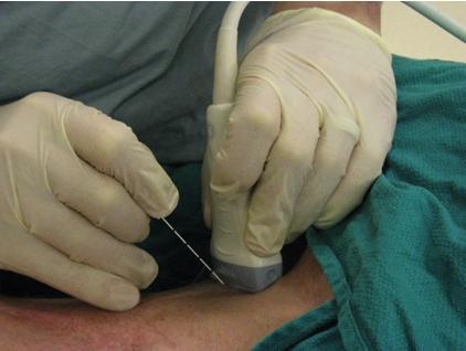 US guided nerve block In plane/ out of plane OOP: easier threading of catheter, familiar approach, shorter needle travel.