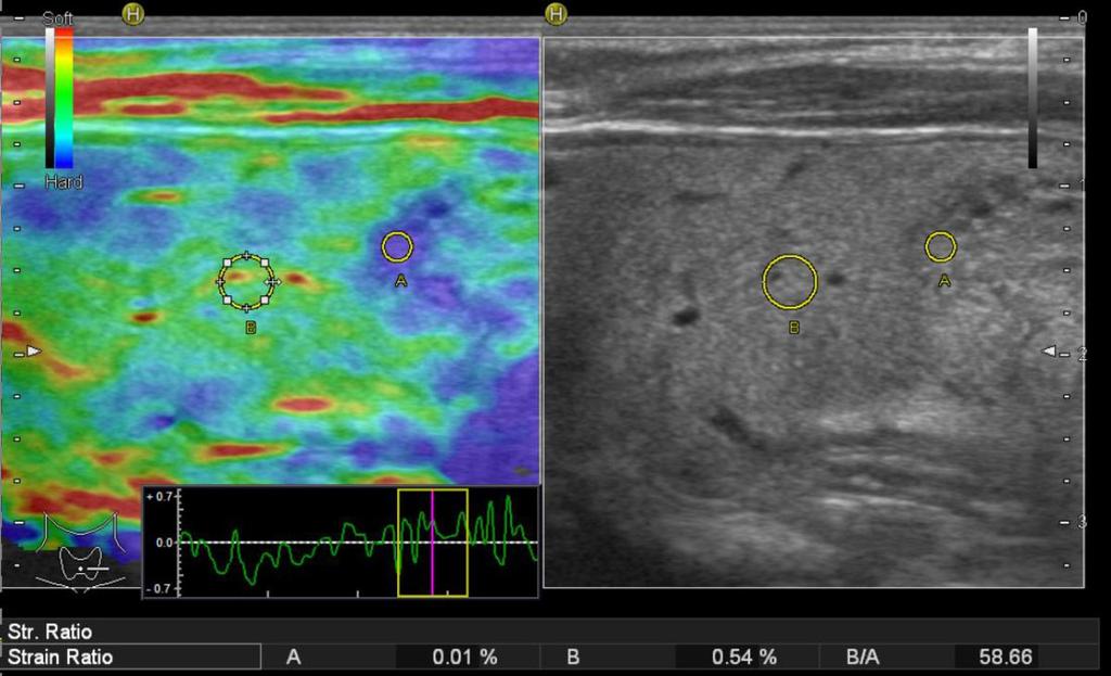 Fig. 3: Free hand ultrasound compression elastogram: same nodule as Fig. 1.