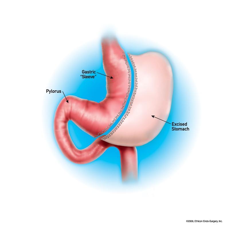 Outpatient Gastric Sleeve A New Option