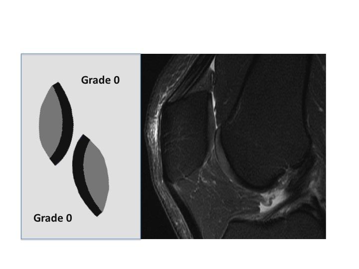 Bone marrow edema like lesions (BME) can be evaluated in the subchondral bone and adjacent marrow if poorly marginated areas of increased signal intensity are visible in the subchondral epiphyseal
